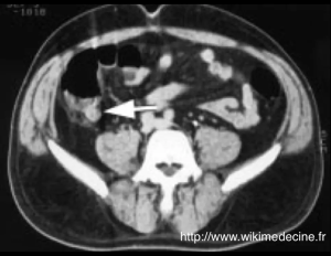 Apendicitis aguda - TC abdominal con inyección de contraste - inflamación apendicular y ulceración