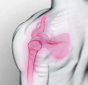 Capsulitis retráctil ("hombro congelado")