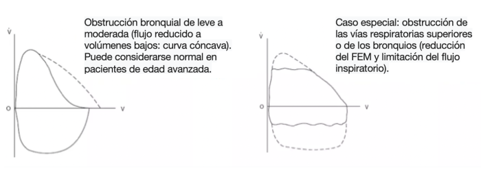 Pruebas de función respiratoria (PFR) - Curvas flujo-volumen en un síndrome obstructivo